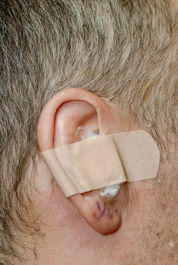 Stapedectomy Mister Ian's log