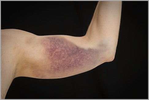 arm with bruise