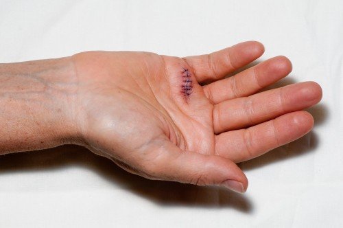Stitches in Hand